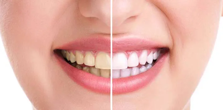 Receitas Caseiras para Clarear Dentes - Clareamento dental